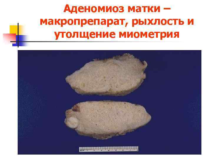 Аденомиоз матки – макропрепарат, рыхлость и утолщение миометрия 