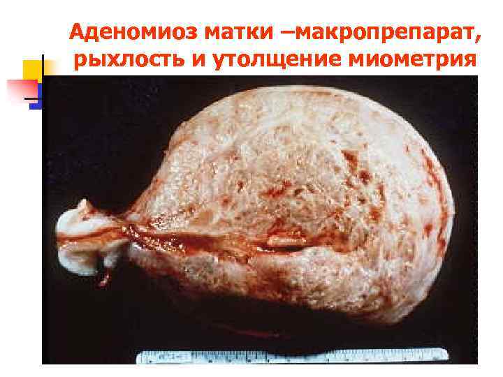 Аденомиоз матки –макропрепарат, рыхлость и утолщение миометрия 