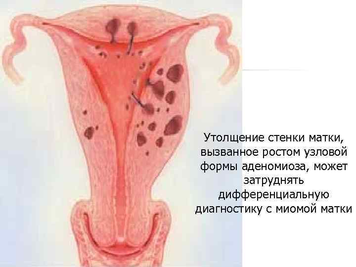 Утолщение стенки матки, вызванное ростом узловой формы аденомиоза, может затруднять дифференциальную диагностику с миомой