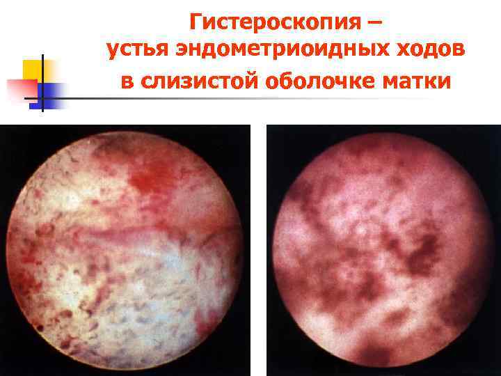 Гистероскопия – устья эндометриоидных ходов в слизистой оболочке матки 