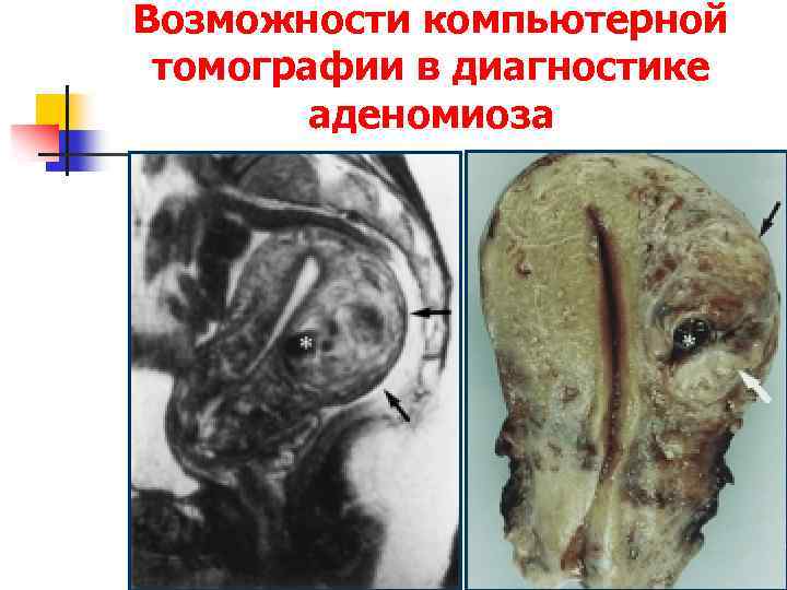 Возможности компьютерной томографии в диагностике аденомиоза 