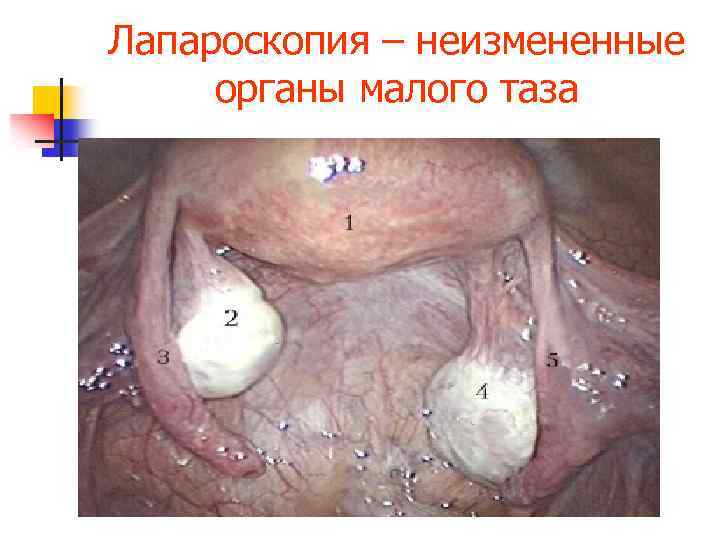 Лапароскопия – неизмененные органы малого таза 