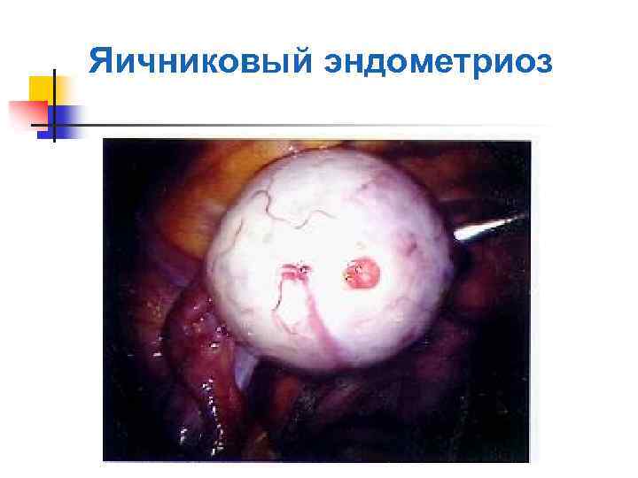 Яичниковый эндометриоз 