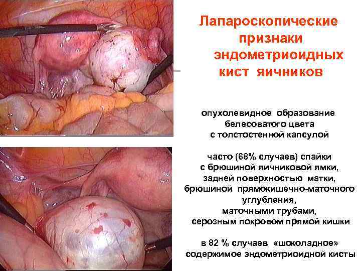 Лапароскопические признаки эндометриоидных кист яичников опухолевидное образование белесоватого цвета с толстостенной капсулой часто (68%