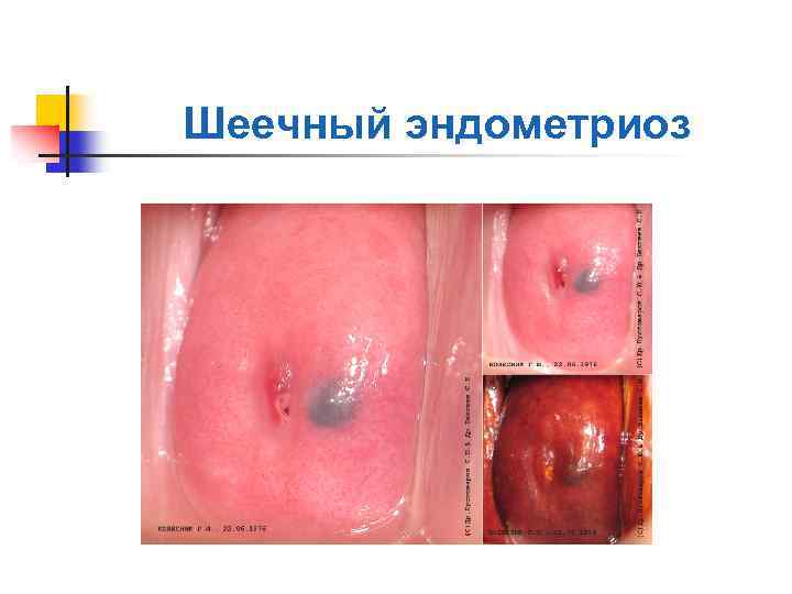 Шеечный эндометриоз 