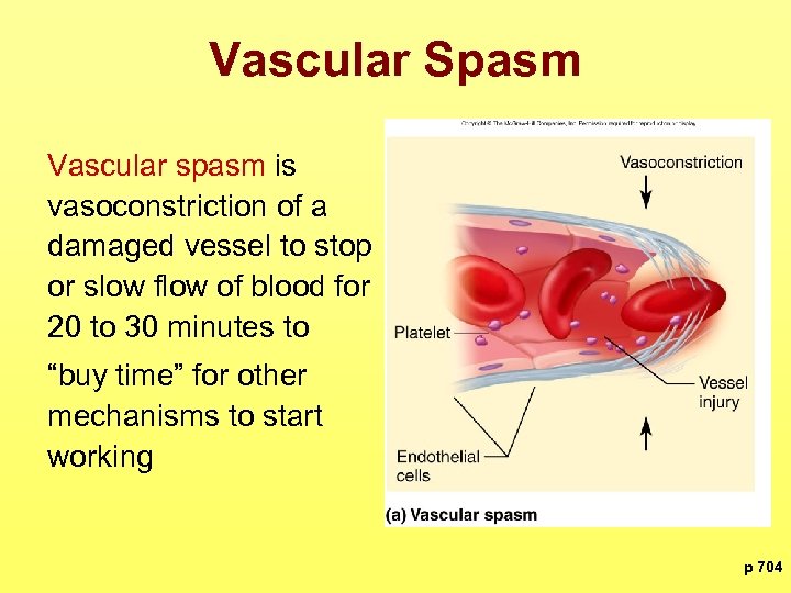 Vascular Spasm Vascular spasm is vasoconstriction of a damaged vessel to stop or slow