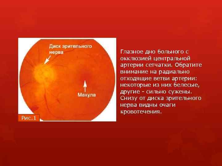 Глазное дно больного с окклюзией центральной артерии сетчатки. Обратите внимание на радиально отходящие ветви