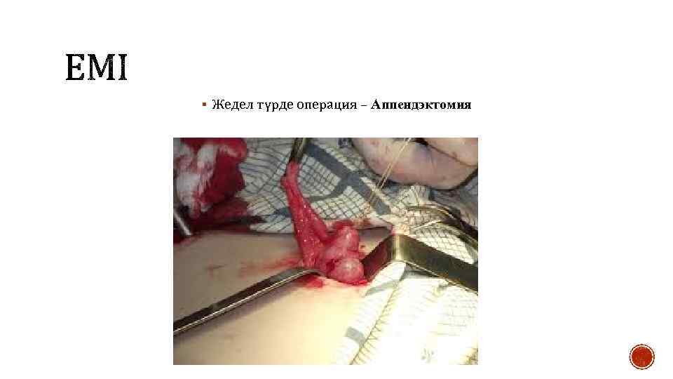 § Жедел түрде операция – Аппендэктомия 