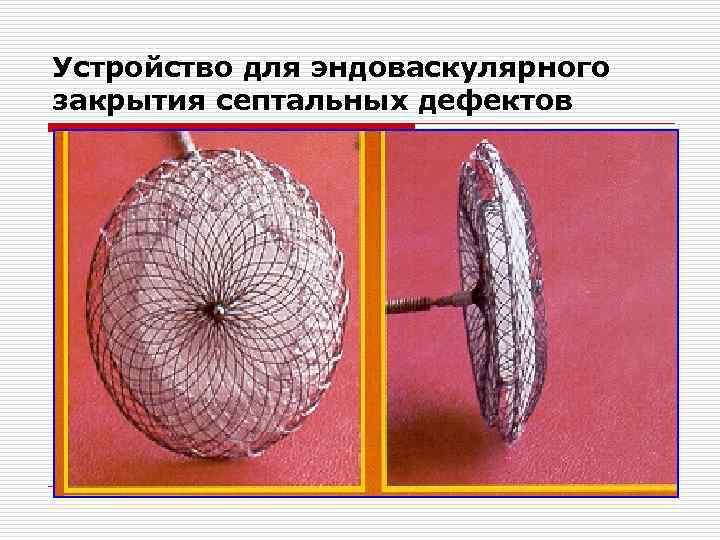 Устройство для эндоваскулярного закрытия септальных дефектов 