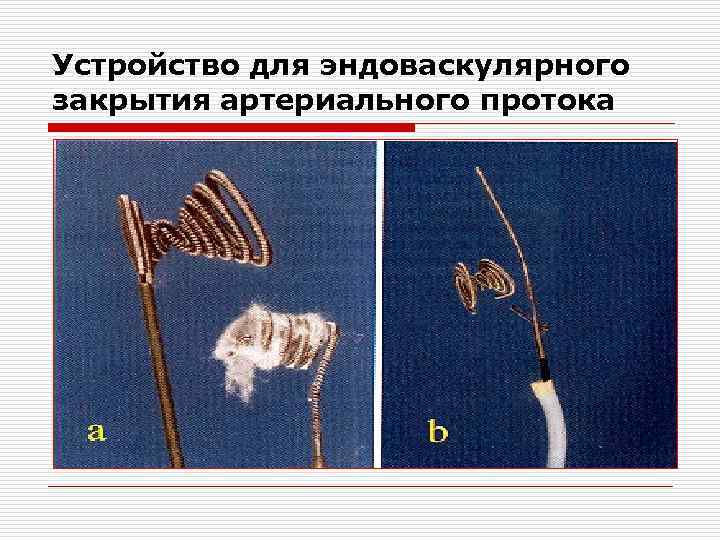 Устройство для эндоваскулярного закрытия артериального протока 