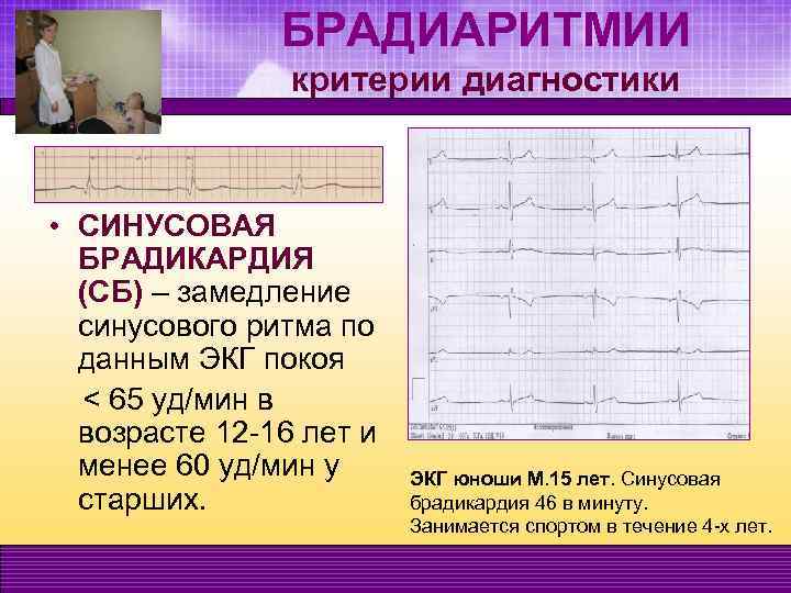 БРАДИАРИТМИИ критерии диагностики • СИНУСОВАЯ БРАДИКАРДИЯ (СБ) – замедление синусового ритма по данным ЭКГ