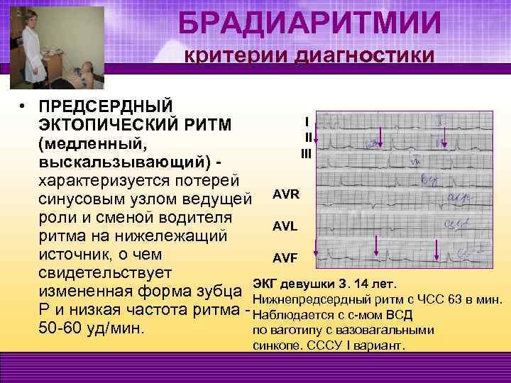 БРАДИАРИТМИИ критерии диагностики • ПРЕДСЕРДНЫЙ I ЭКТОПИЧЕСКИЙ РИТМ II (медленный, III выскальзывающий) характеризуется потерей