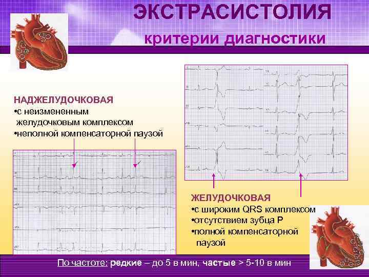 Желудочковая эктопическая активность в виде одиночных экстрасистол