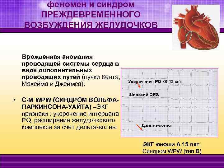 феномен и синдром ПРЕЖДЕВРЕМЕННОГО ВОЗБУЖДЕНИЯ ЖЕЛУДОЧКОВ Врожденная аномалия проводящей системы сердца в виде дополнительных