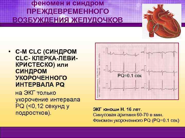 Pq на экг. Синдром укорочения PQ на ЭКГ У детей. Синдром укорочения интервала PQ на ЭКГ. CLC синдром ЭКГ. CLC синдром ЭКГ признаки.