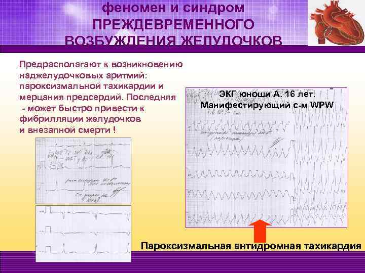 феномен и синдром ПРЕЖДЕВРЕМЕННОГО ВОЗБУЖДЕНИЯ ЖЕЛУДОЧКОВ Предрасполагают к возникновению наджелудочковых аритмий: пароксизмальной тахикардии и