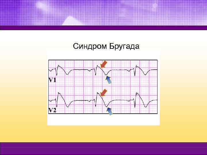 Синдром Бругада 