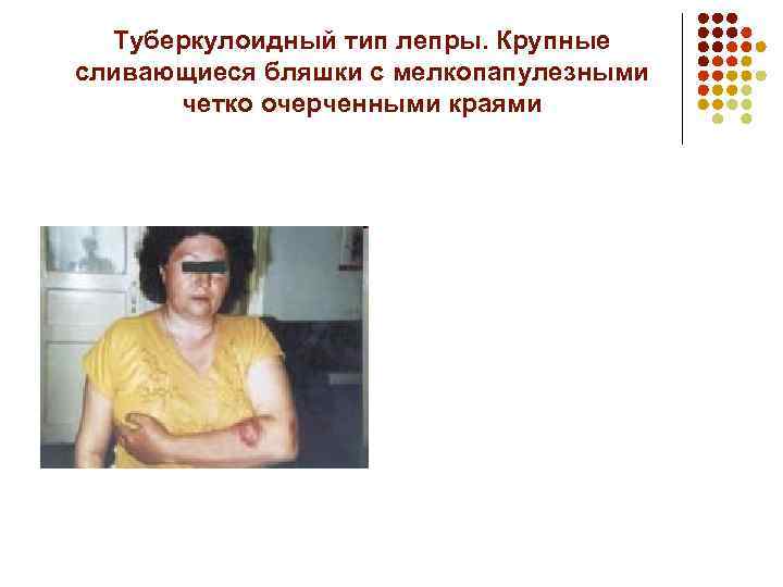 Туберкулоидный тип лепры. Крупные сливающиеся бляшки с мелкопапулезными четко очерченными краями 