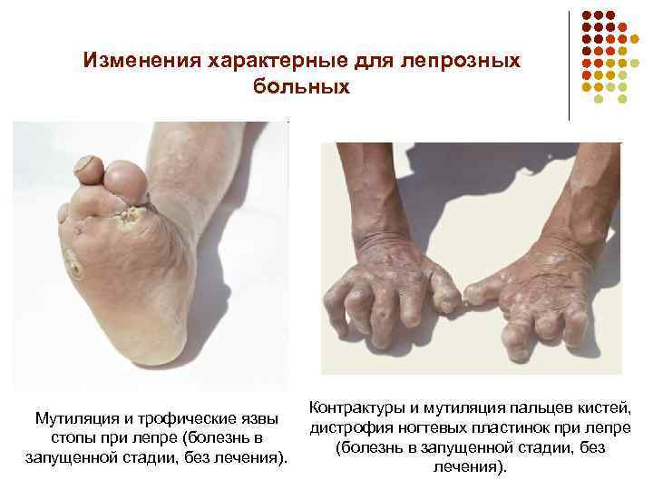 Изменения характерные для лепрозных больных Мутиляция и трофические язвы стопы при лепре (болезнь в