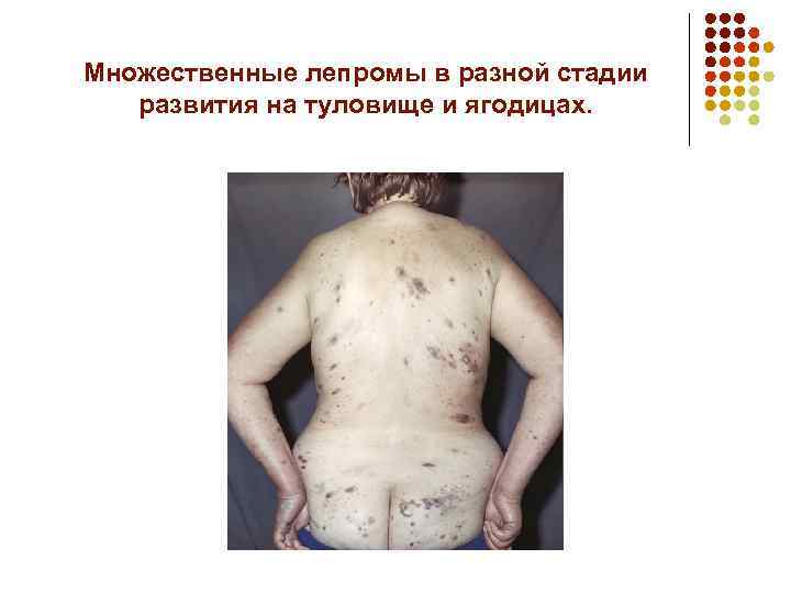 Множественные лепромы в разной стадии развития на туловище и ягодицах. 