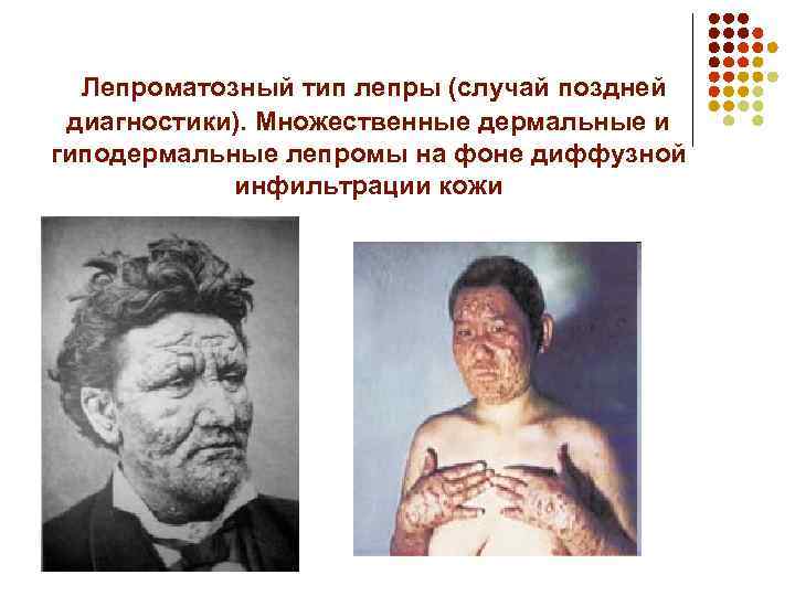 Лепроматозный тип лепры (случай поздней диагностики). Множественные дермальные и гиподермальные лепромы на фоне диффузной