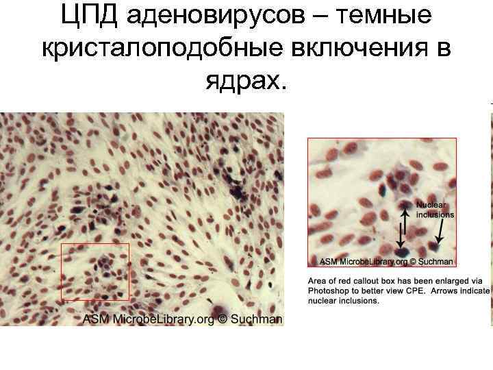 ЦПД аденовирусов – темные кристалоподобные включения в ядрах. 