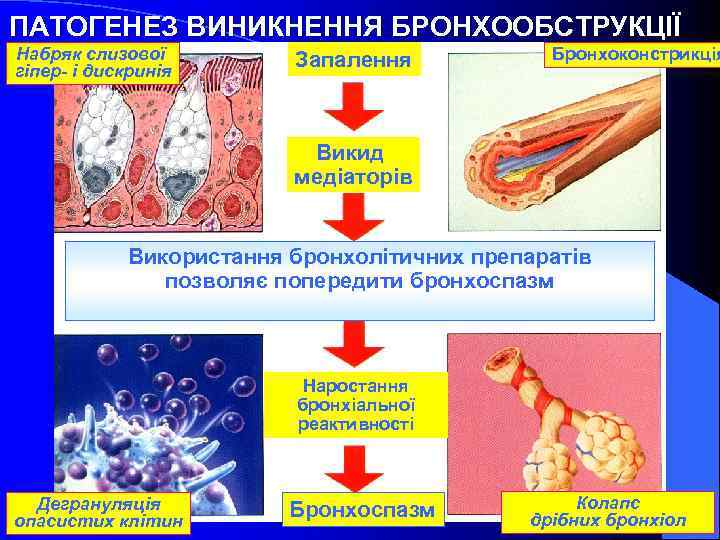 ПАТОГЕНЕЗ ВИНИКНЕННЯ БРОНХООБСТРУКЦІЇ Набряк слизової гіпер- і дискринія Запалення Бронхоконстрикція Викид медіаторів Використання бронхолітичних