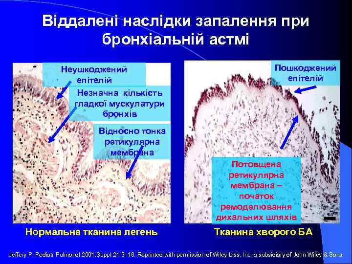 Віддалені наслідки запалення при бронхіальній астмі Неушкоджений епітелій Незначна кількість гладкої мускулатури бронхів Пошкоджений