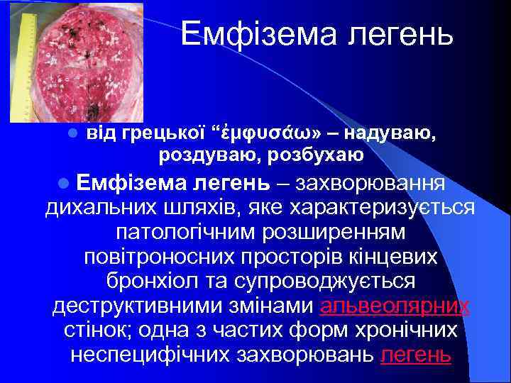 Емфізема легень l від грецької “ἐμφυσάω» – надуваю, розбухаю l Емфізема легень – захворювання