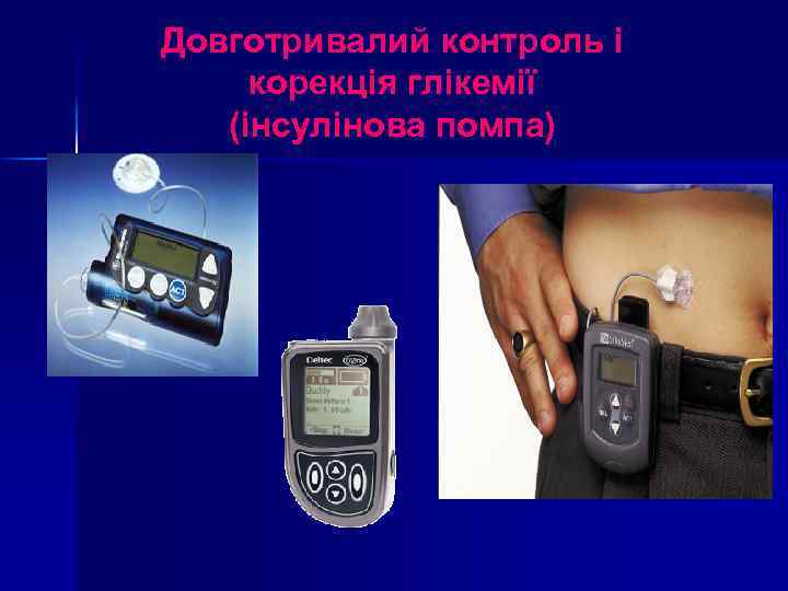 Довготривалий контроль і корекція глікемії (інсулінова помпа) 