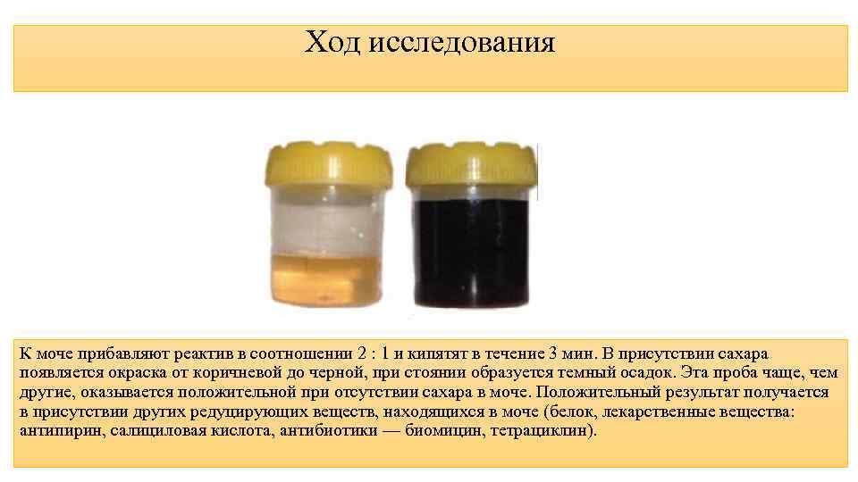 Ход исследования К моче прибавляют реактив в соотношении 2 : 1 и кипятят в