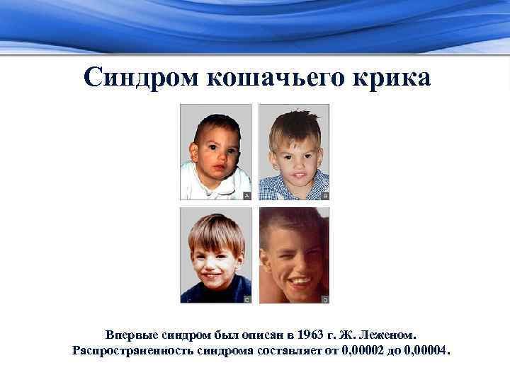 Синдром кошачьего крика Впервые синдром был описан в 1963 г. Ж. Леженом. Распространенность синдрома