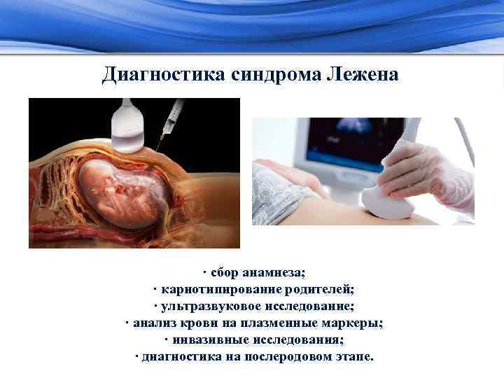 Диагностика синдрома Лежена · сбор анамнеза; · кариотипирование родителей; · ультразвуковое исследование; · анализ