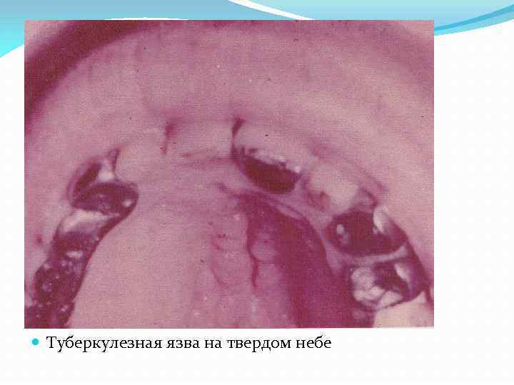  Туберкулезная язва на твердом небе 