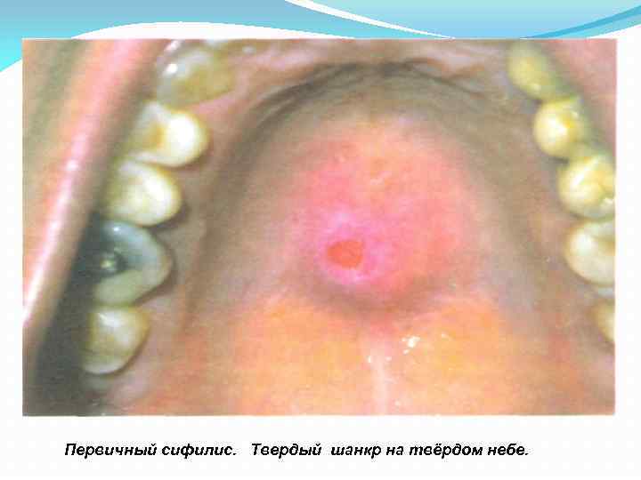 поверхности Первичный сифилис. Твердый шанкр на твёрдом небе. 