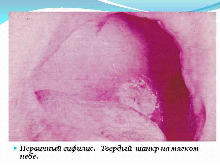  Первичный сифилис. Твердый шанкр на мягком небе. 