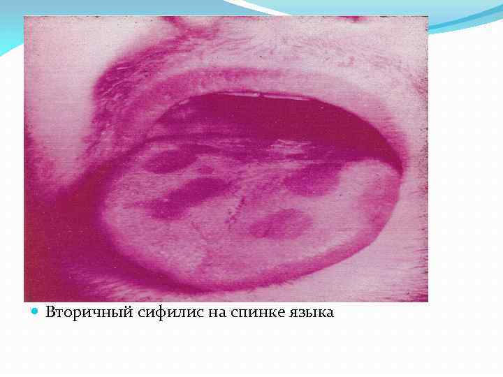  Вторичный сифилис на спинке языка 