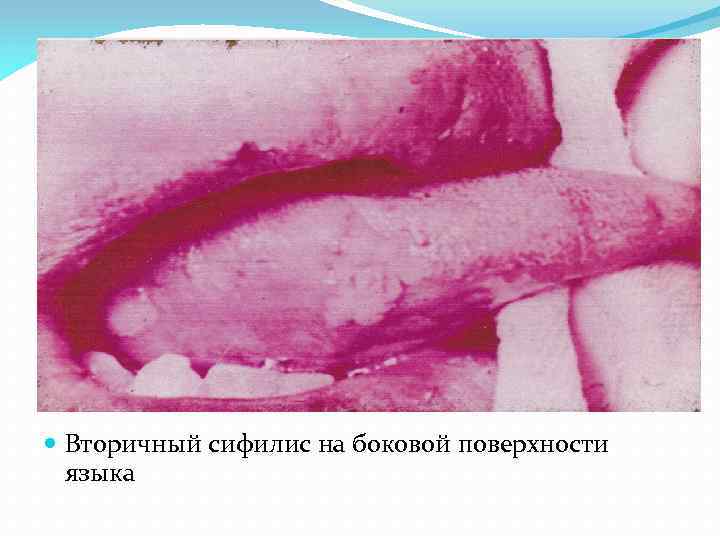  Вторичный сифилис на боковой поверхности языка 