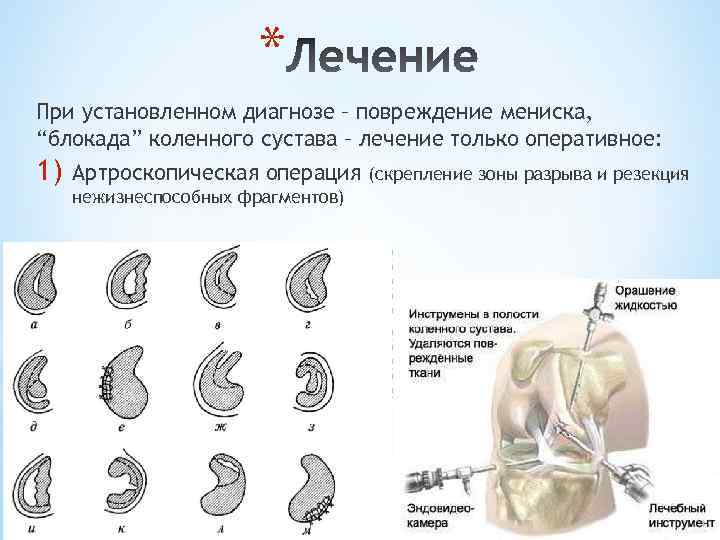 * При установленном диагнозе – повреждение мениска, “блокада” коленного сустава – лечение только оперативное: