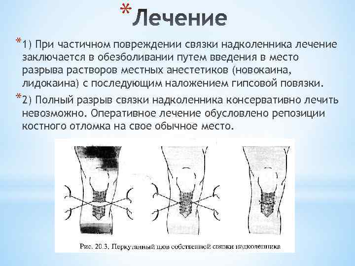 * *1) При частичном повреждении связки надколенника лечение заключается в обезболивании путем введения в