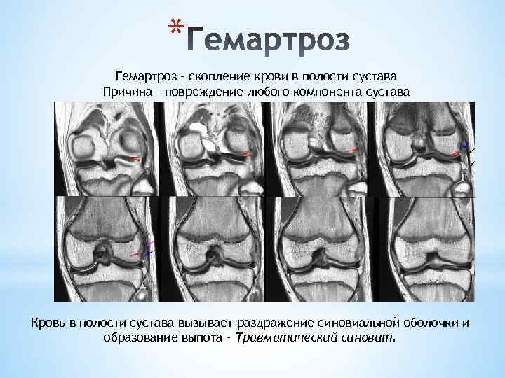 * Гемартроз – скопление крови в полости сустава Причина – повреждение любого компонента сустава