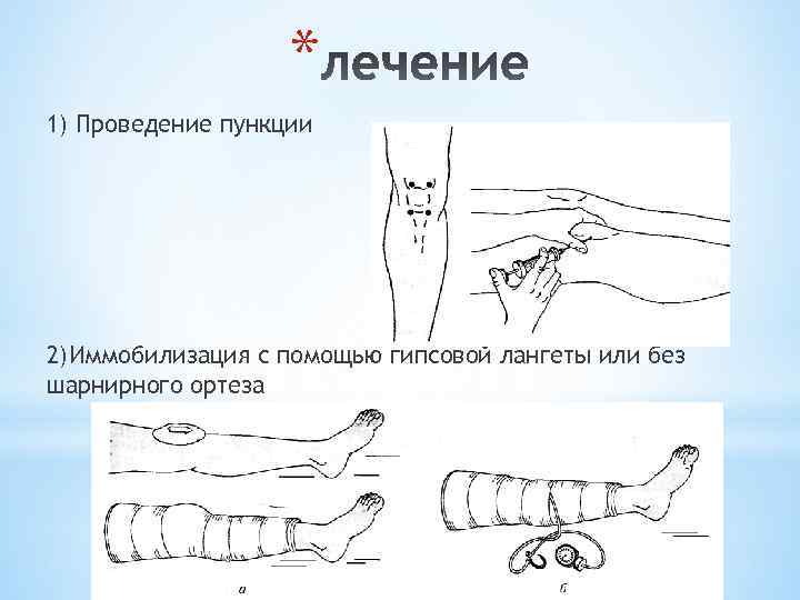 * 1) Проведение пункции 2)Иммобилизация с помощью гипсовой лангеты или без шарнирного ортеза 