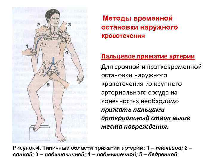 Картинки пальцевое прижатие артерии