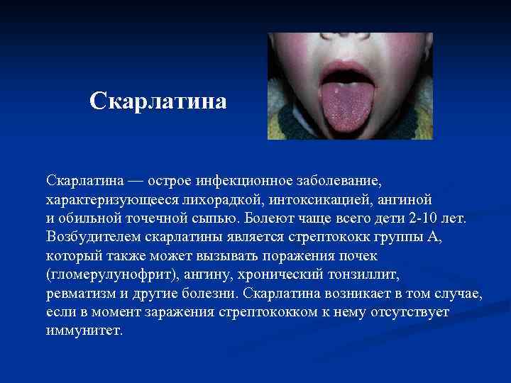  Скарлатина — острое инфекционное заболевание, характеризующееся лихорадкой, интоксикацией, ангиной и обильной точечной сыпью.