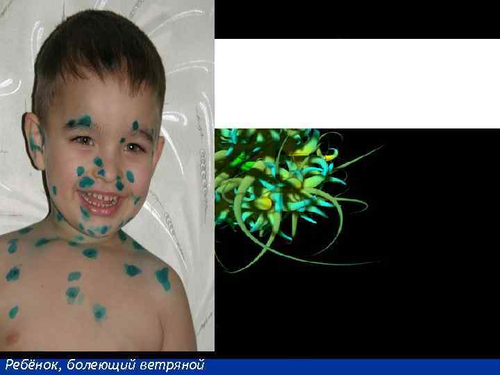 Ветряная оспа - острое инфекционное заболевание, преимущественно детского возраста, характеризующееся лихорадкой, умеренной общей интоксикацией