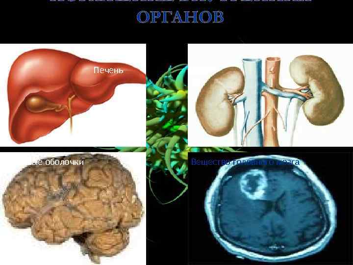 ПОРАЖЕНИЕ ВНУТРЕННИХ ОРГАНОВ Печень Мозговые оболочки Почки Вещество головного мозга 