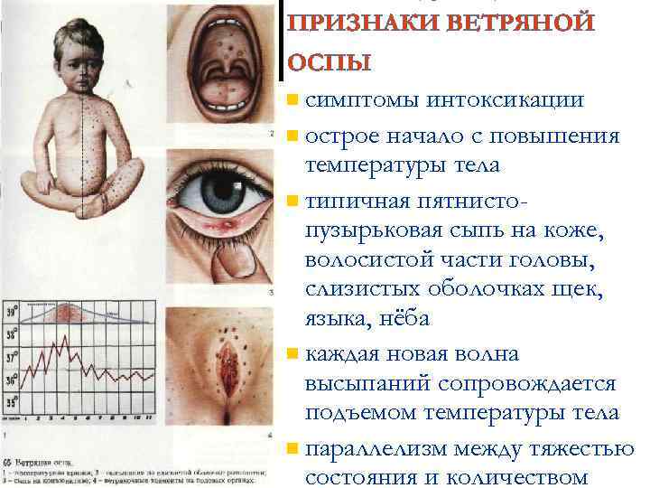 КЛИНИЧЕСКИЕ ПРИЗНАКИ ВЕТРЯНОЙ ОСПЫ n симптомы интоксикации n острое начало с повышения температуры тела