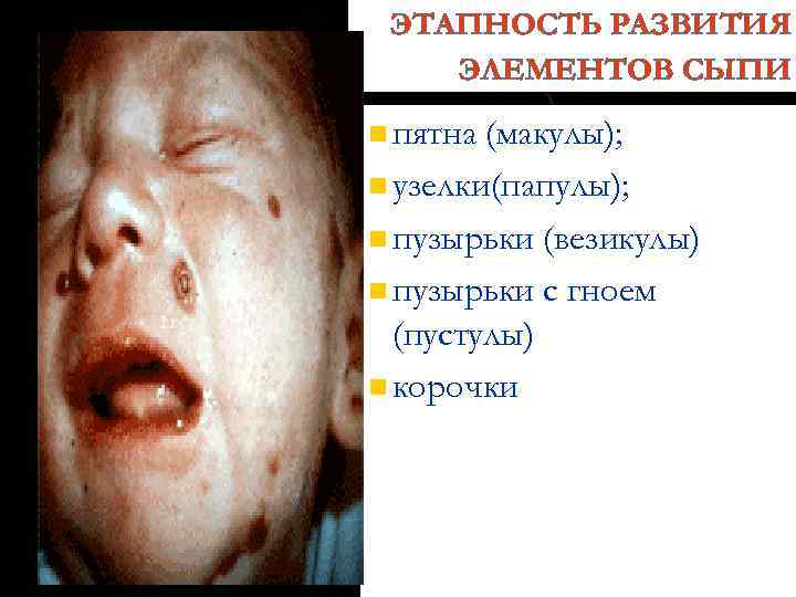 ЭТАПНОСТЬ РАЗВИТИЯ ЭЛЕМЕНТОВ СЫПИ n пятна (макулы); n узелки(папулы); n пузырьки (везикулы) n пузырьки