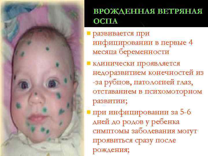ВРОЖДЕННАЯ ВЕТРЯНАЯ ОСПА n развивается при инфицировании в первые 4 месяца беременности n клинически