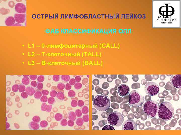 ОСТРЫЙ ЛИМФОБЛАСТНЫЙ ЛЕЙКОЗ ФАБ КЛАССИФИКАЦИЯ ОЛЛ • L 1 – 0 -лимфоцитарный (CALL) •
